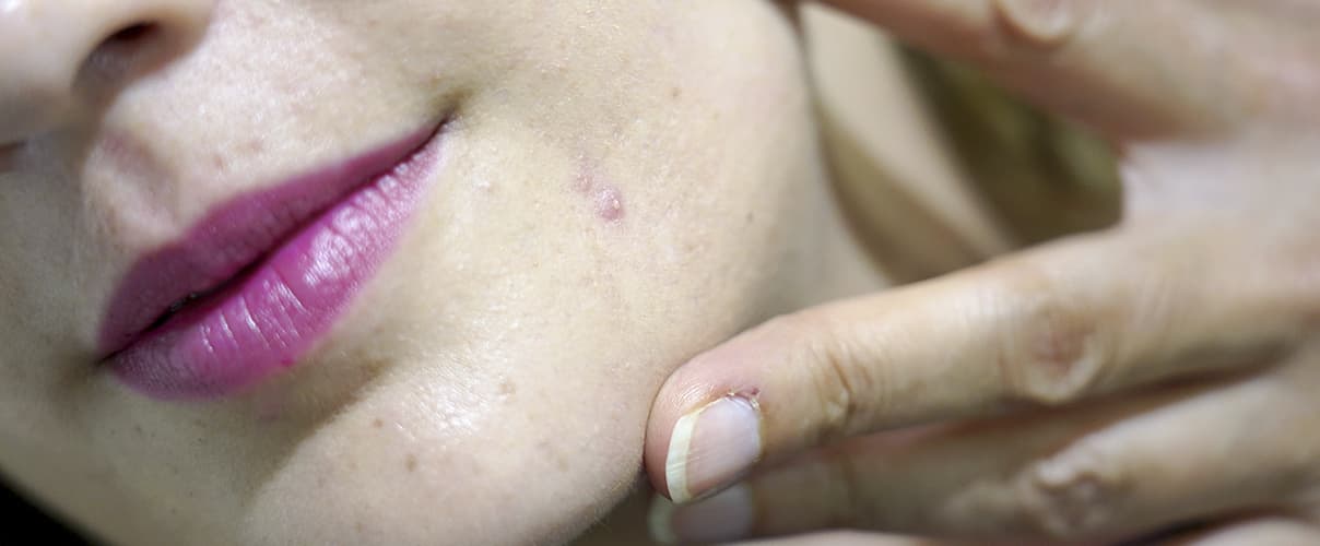 Information about acne Información sobre el acné: síntomas, causas, tipos, diagnóstico y tratamiento