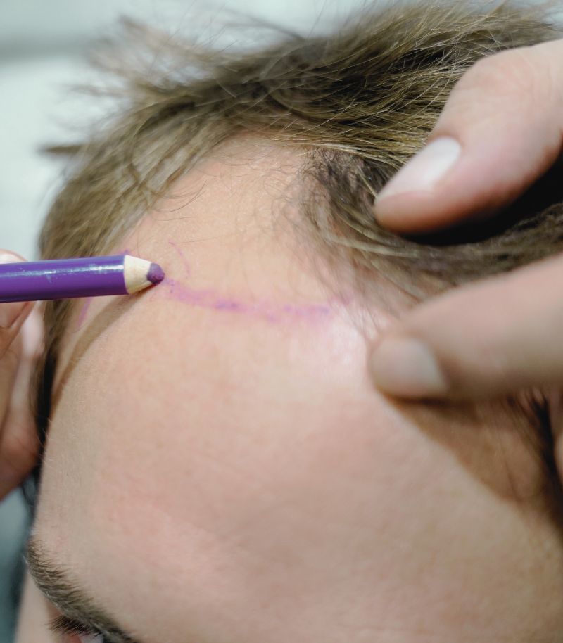 We Apply all Hair Transplant Techniques with Natural Results We Apply all Hair Transplant Techniques with Natural Results